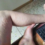 孕妇为什么会得湿疹,孕期湿疹原因有哪些