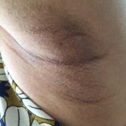 怀孕腋下变黑怎么办,孕期腋下变黑怎么恢复正常