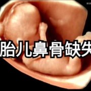12周胎儿鼻骨缺失是畸形吗,胎儿鼻骨缺失是畸形吗图片