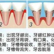 孕期牙周炎怎么治疗（孕期牙周炎怎么治疗）