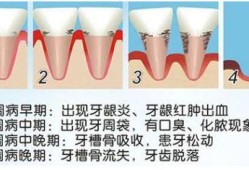 孕期牙周炎怎么治疗（孕期牙周炎怎么治疗）