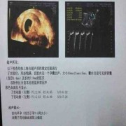 怀孕早期胎心胎芽出现的晚是什么原因造成的,胎心出现晚的孩子健康吗