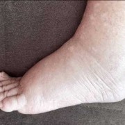 孕期水肿什么时候开始（孕妇多少周开始浮肿的啊？怀孕有三个月了的）
