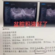 孕期有积液有什么影响（怀孕有积液是什么原因造成的）