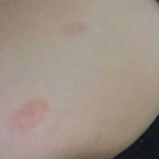 孕期乳头起皮（孕期乳头起皮）