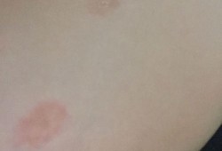 孕期乳头起皮（孕期乳头起皮）