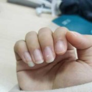 孕期身上有白点（指甲上有白斑是怎么回事）