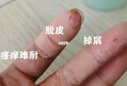 孕期长湿疹怎么用药（孕期长湿疹怎么用药）