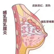 产妇乳腺管堵塞怎么办,孕期乳腺管堵塞