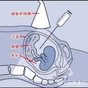 羊水穿刺12天胎儿死亡（羊水穿刺检查做完了宝宝生下来会健康吗）