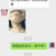 孕期皮炎的治疗方法（孕期皮炎的治疗方法有哪些）