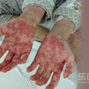 孕期白血病（孕期白血病有什么症状）