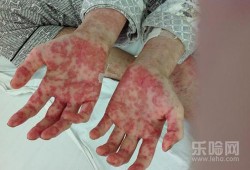 孕期白血病（孕期白血病有什么症状）