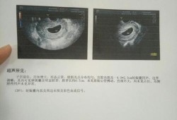 18周胎儿视频（怀孕18周胎心不好找是因为小孩在宫内到处跑吗）