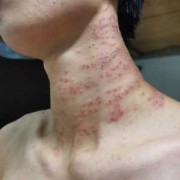 备孕期间男方吃了治疗湿疹的药，会对胚胎有影响吗,备孕期间阴部痒怎么办啊
