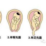 胎儿先露（胎儿先露）