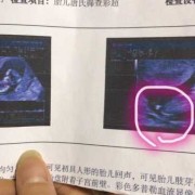 孕14周，胎儿NT厚约0.3cm是什么,怀孕14周胎儿彩超图片