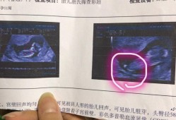 孕14周，胎儿NT厚约0.3cm是什么,怀孕14周胎儿彩超图片