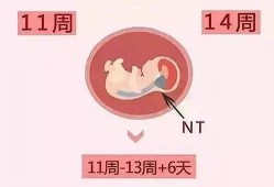 nt增厚胎儿正常的概率（nt增厚羊穿容易过吗）