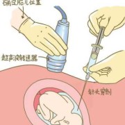 羊水穿刺前，要做什么准备,羊水穿刺能查出胎儿血型吗