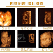 孕期大排畸和四维区别（孕期大排畸和四维区别大吗）