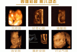 孕期大排畸和四维区别（孕期大排畸和四维区别大吗）