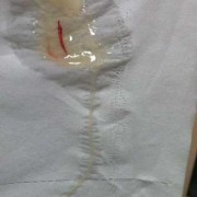 怀孕期间白带多是男孩（怀孕期间白带多是男孩）