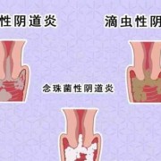孕期白带黄稠（白带发黄粘稠是怎么回事）