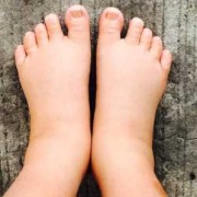 孕期怎么去水肿（孕妇的脚肿吃什么可以消肿）