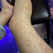备孕期间男方吃了治疗湿疹的药，会对胚胎有影响吗,备孕期间有湿疹怎么办啊