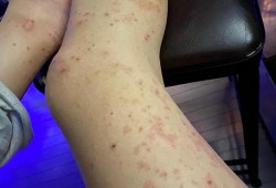 备孕期间男方吃了治疗湿疹的药，会对胚胎有影响吗,备孕期间有湿疹怎么办啊