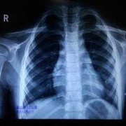 孕妇拍了x光怎么办，一次x线对孕早期有什么影响,孕期x线检查哪个部位对胎儿影响较大