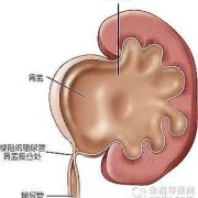 肾积水多少毫米算严重,胎儿肾积水多少不能要孩子