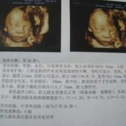 胎儿常规彩超检查什么（宝宝四维彩超是什么）