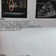孕期做nt的最佳时间（做nt的周数怎么算）