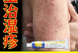 孕妇湿疹怎样快速止痒有什么好的办法的吗，快要用湿疹药膏的吗,孕妇湿疹对胎儿有影响吗图片