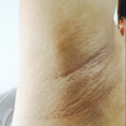 怀孕腋下变黑是怎么回事,孕期腋窝发黑是男孩还是女孩