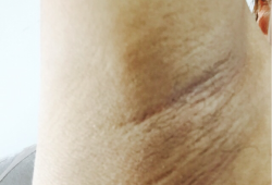 怀孕腋下变黑是怎么回事,孕期腋窝发黑是男孩还是女孩
