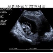 胎儿声像图（胎儿声像图是什么意思）