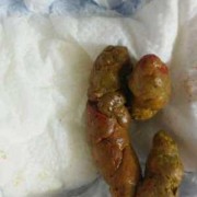 孕妇便秘，拉大便好多血是怎么回事呢,孕期拉血对胎儿有影响吗