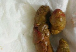 孕妇便秘，拉大便好多血是怎么回事呢,孕期拉血对胎儿有影响吗