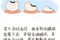 孕期牙齿松动（孕晚期一颗牙齿松动快要掉了有没有什么补救的方法）