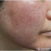 请问玫瑰痤疮怎么治疗,孕期玫瑰痤疮复发怎么办