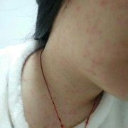 备孕期间吃了过敏药，对怀孕有影响吗,备孕期过敏怎么办啊