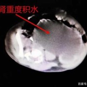 胎儿双肾积水怎么治疗（胎儿有肾积水，孕妇最好适合哪种生产方式）