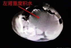 胎儿双肾积水怎么治疗（胎儿有肾积水，孕妇最好适合哪种生产方式）