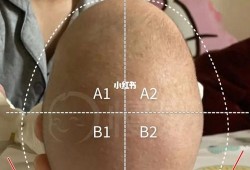 四个月宝宝舟状头还能矫正吗,胎儿颅骨呈舟状正常吗图片