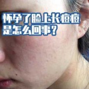 怀孕长痘痘怎么回事,怀孕期间长痘痘是什么原因