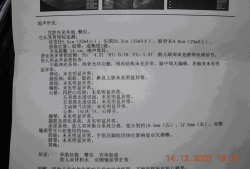 新生儿肾积水怎么办,胎儿左肾轻度积水是什么意思