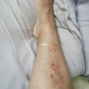 孕晚期孕妇湿疹手脚都有，奇痒无比，怎么办呀,孕期湿疹怎么止痒最快